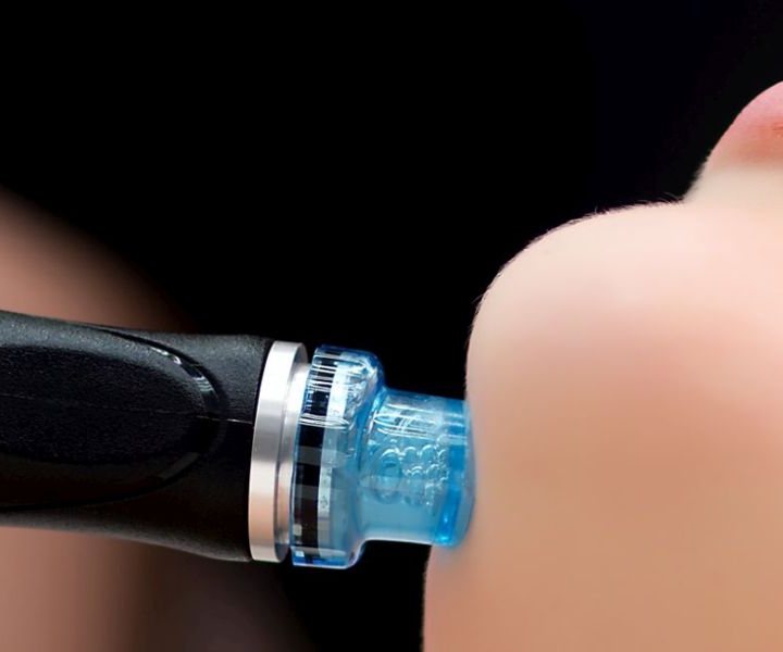 Nahaufnahme einer Aqua-Facial-Behandlung: der Aufsatz mit Wirkstofflösung gleitet über die Wange