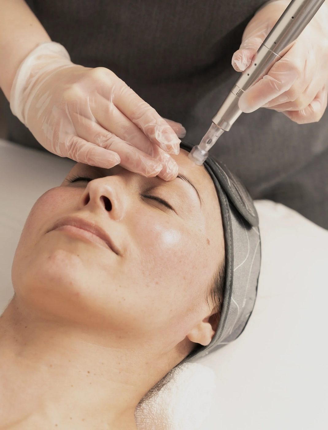 Microneedling-Behandlung: der Pen wird mit feinen Nadeln über die Stirn geführt