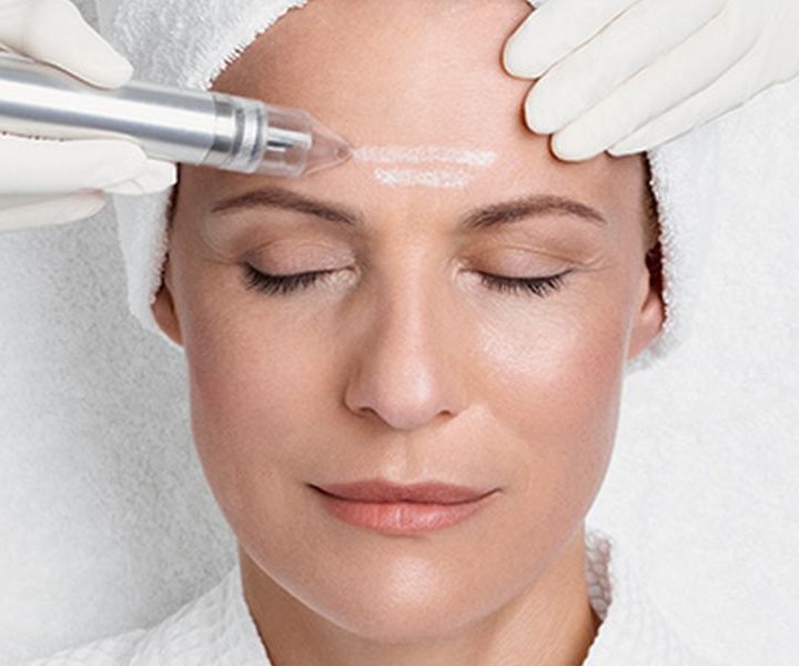 Mikrodermabrasion: der SkinPeeler-Handgriff gleitet über die Stirn einer entspannt liegenden Kundin